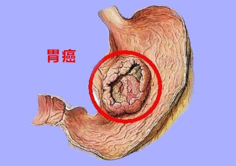 小心贫血皮肌炎都可能是胃癌的表现