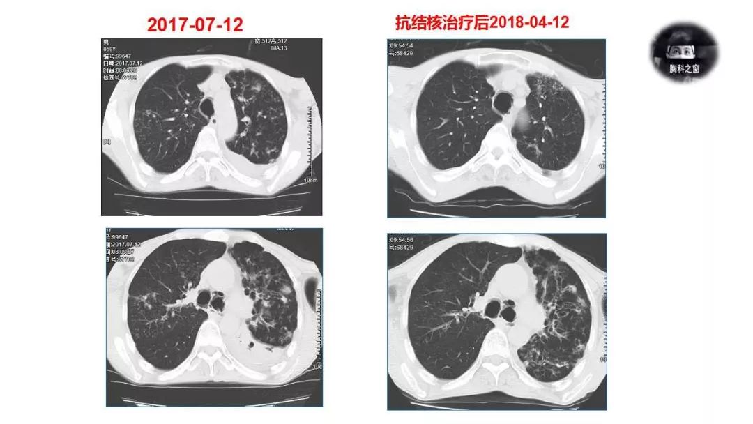 mdt大咖秀段慧萍吴吉丽囊性支气管扩张背后的故事