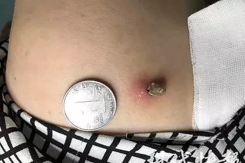 老人胸前长了个瘊子是活的还会动好多人都中招