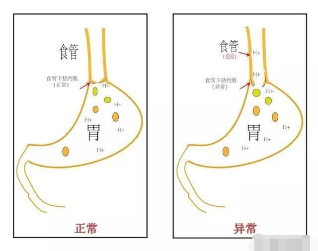 还在因为胃食管反流病睡不好觉这三个方法可有效改善