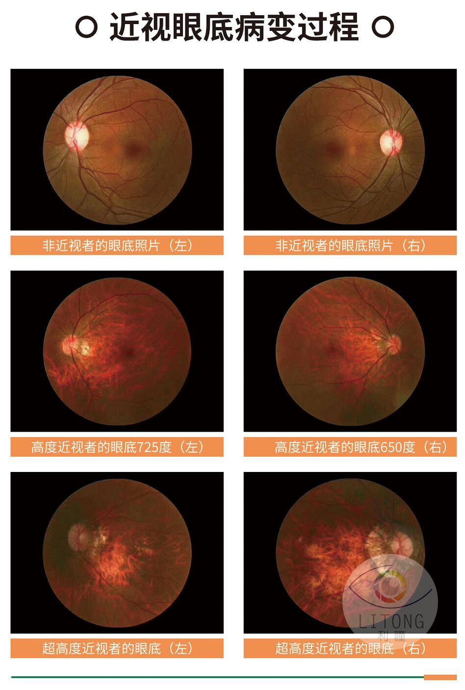 高考结束近视手术迎高峰眼科主任几分钟的近视手术不可能一劳永逸