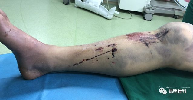凶险的骨筋膜室综合征昆骨专家精确诊断及时手术