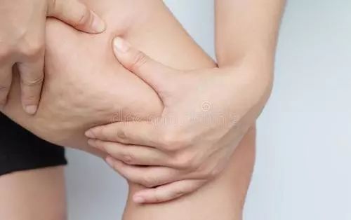 关于大腿粗,肌肉型小腿…你想知道的都在这里!_脂肪型