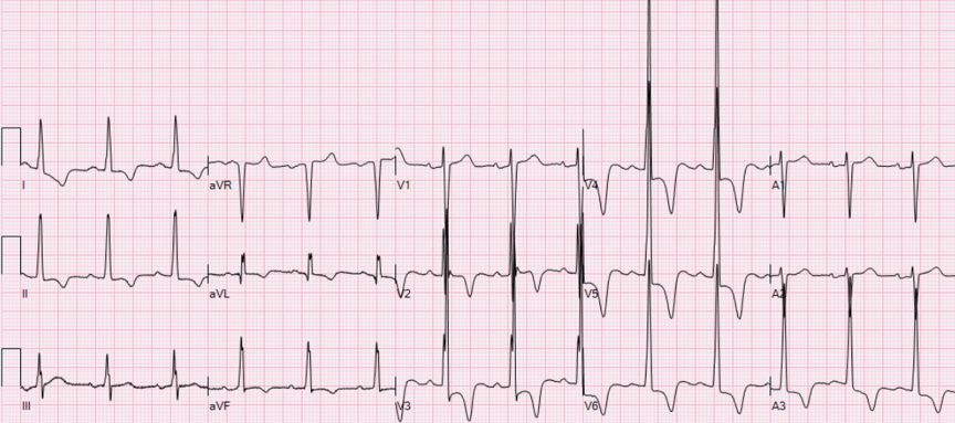 10 小时病例 1:胸痛伴右下肢活动障碍 2 小时先请大家通过下面的心电