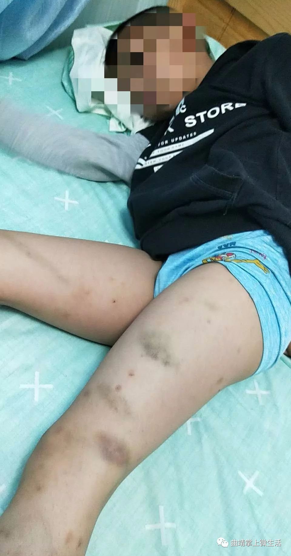 云南曲靖七岁男童遭体罚满腿淤青涉事老师被处分了
