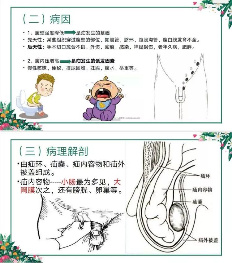 地医护理外一科护理业务查房腹外疝的围手术期护理
