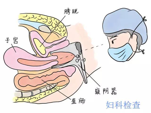 宮頸的青春痘宮頸囊腫你知道多少