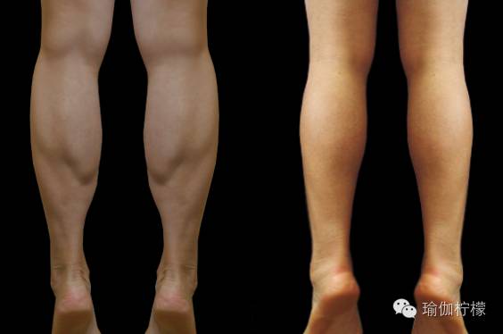 小腿肌肉疝图片