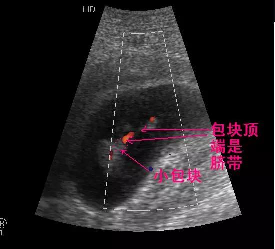 從胎兒消化系統發育理解生理性中腸疝