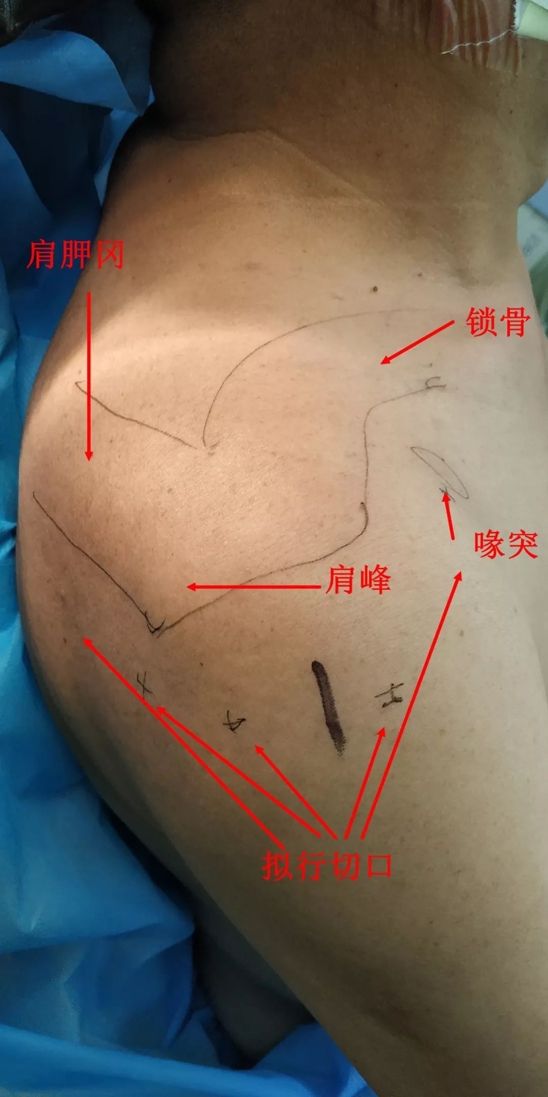我院成功完成首例肩关节镜下肩袖损伤修复术