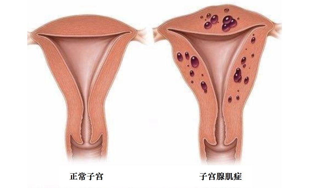 子宫腺肌症:妇科不死的癌症,饮食牢记这4点,或能悄悄缓解