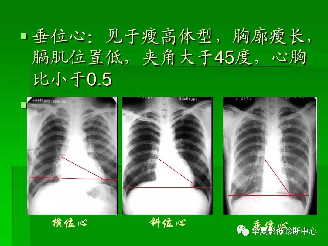 考试必备心脏x线各种位置详解