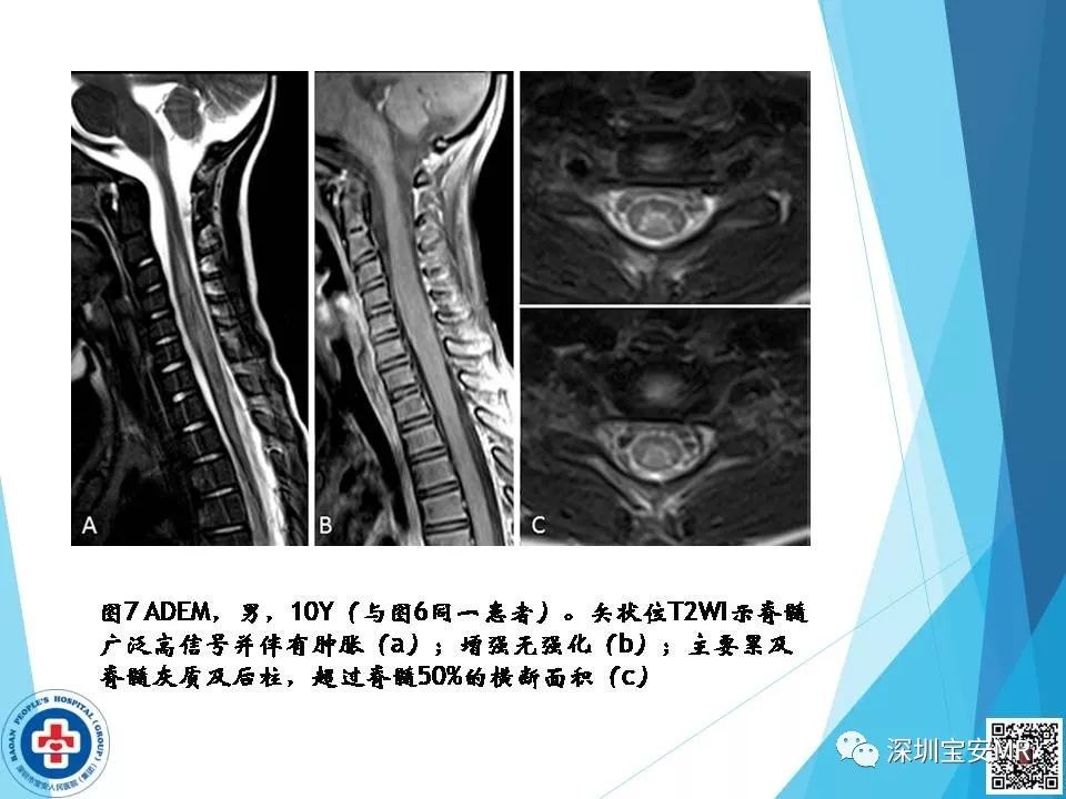 急性播散性腦脊髓炎及其它急性類感染綜合徵