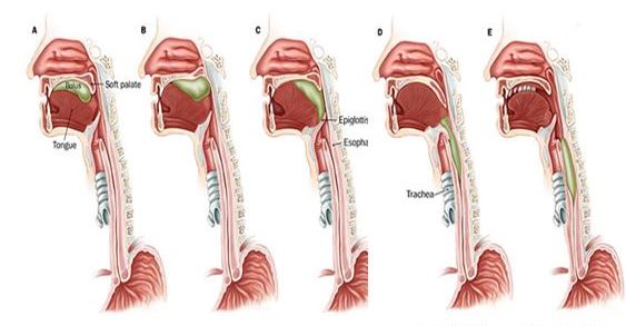脑卒中后吞咽障碍的康复训练总结
