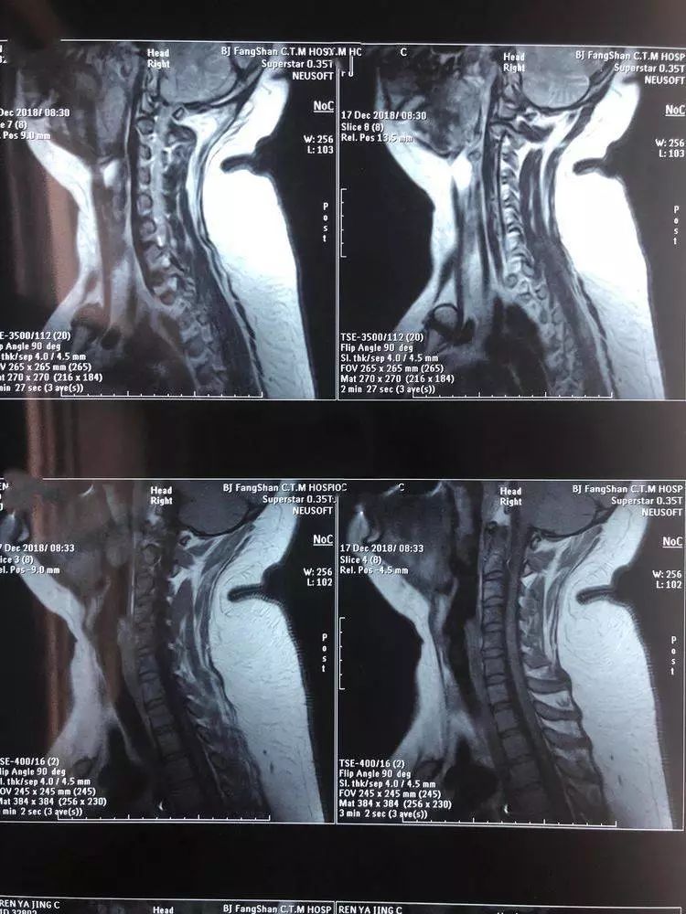 中医适宜技术,消除"富贵包"!