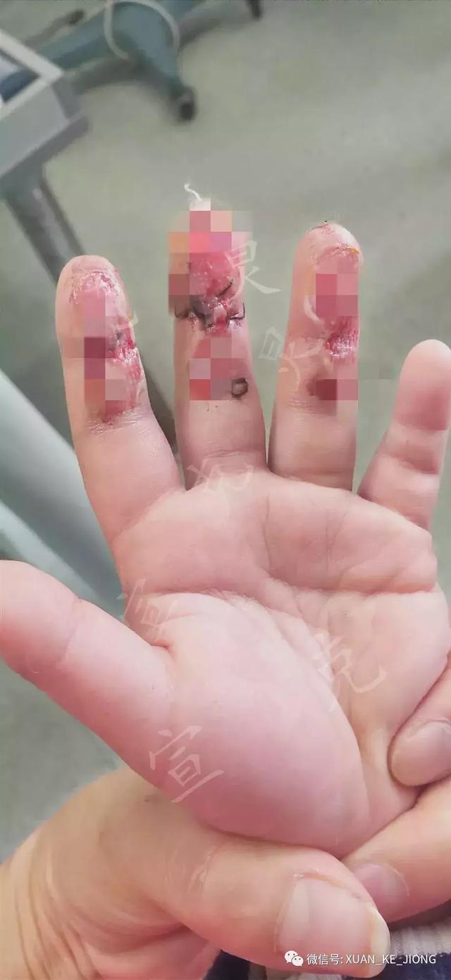 申晨间十指连心上海5龄童手指被扎伤游乐设施存隐患