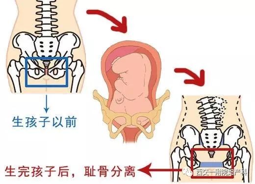 妊娠期疼痛之耻骨分离