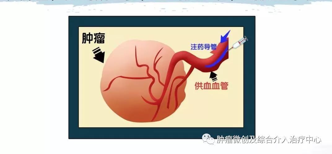 胰腺癌的介入治疗是什么意思胰腺长瘤能活多久