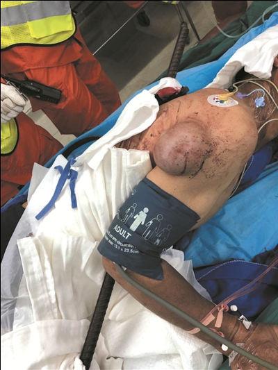 工人在施工过程中,不慎发生意外,被一根1米多长的钢筋从背部刺穿身体