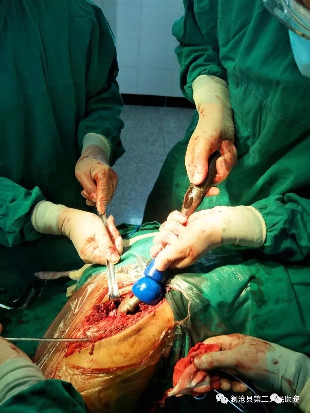 便民上允澜沧县第二人民医院开展首例髋关节置换术