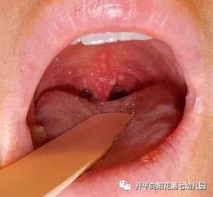 口腔及咽喉出现灰白色疱疹食欲差嗓子痛高热主要症状1-7岁儿童易感