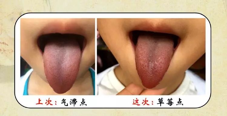 小儿舌诊之点刺舌之气滞点