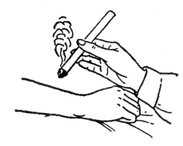 夏季艾灸会上火吗