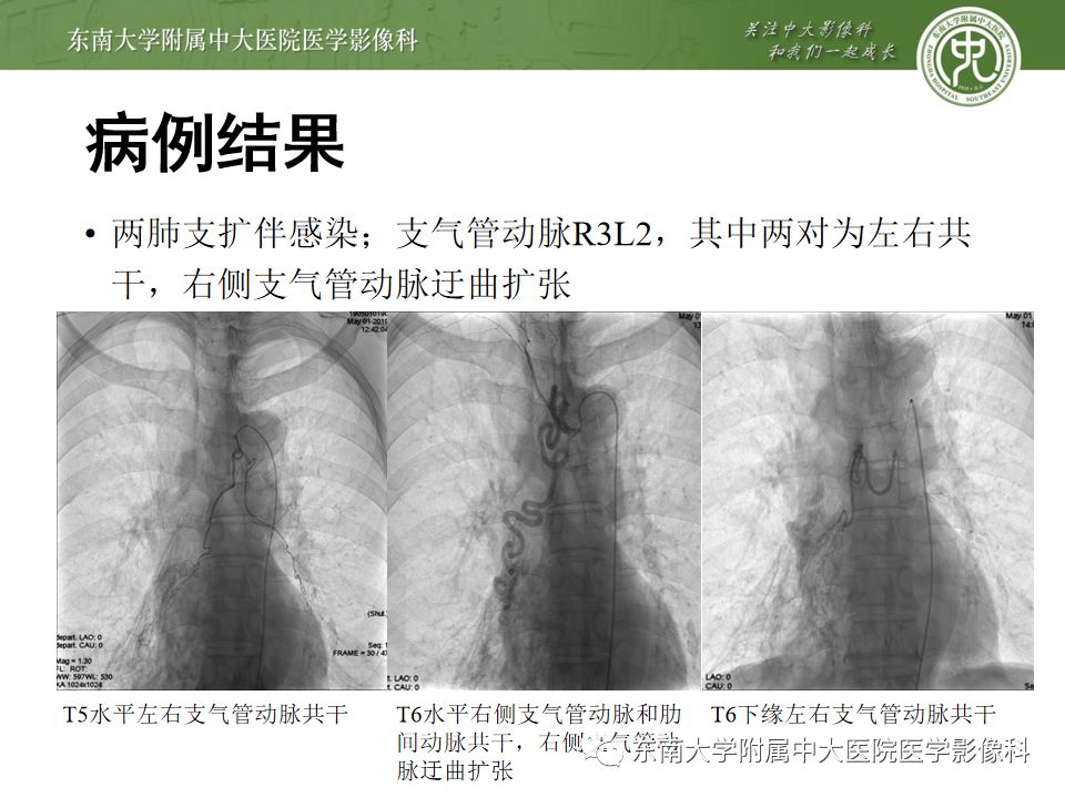 支氣管動脈解剖及異常影像表現