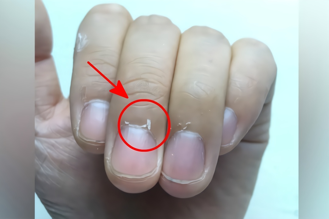 指甲周围长出倒刺是身体发出的什么信号今天可算知道了