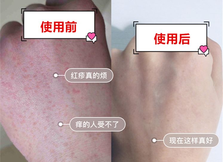 明知道挤破皮肤不好奇痒无比,反复发作如蚂蚁浑身乱转解奇痒痒湿癣疹