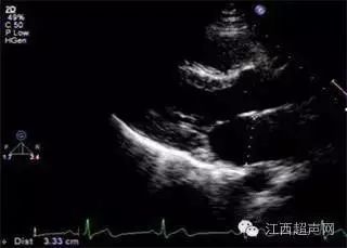舒张期分别测量)01美国超声心动图学会(ase)关于心腔定量分析的指南