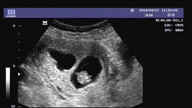 怀孕50天婴儿图片图片