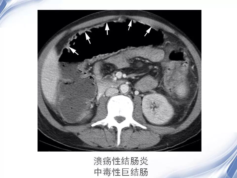 炎症性肠病的ctmri诊断影像天地