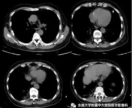 支气管动脉解剖及异常影像表现