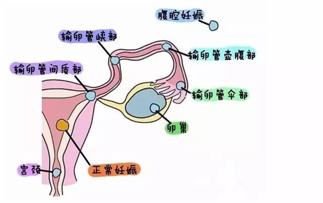 宫外孕风险图片