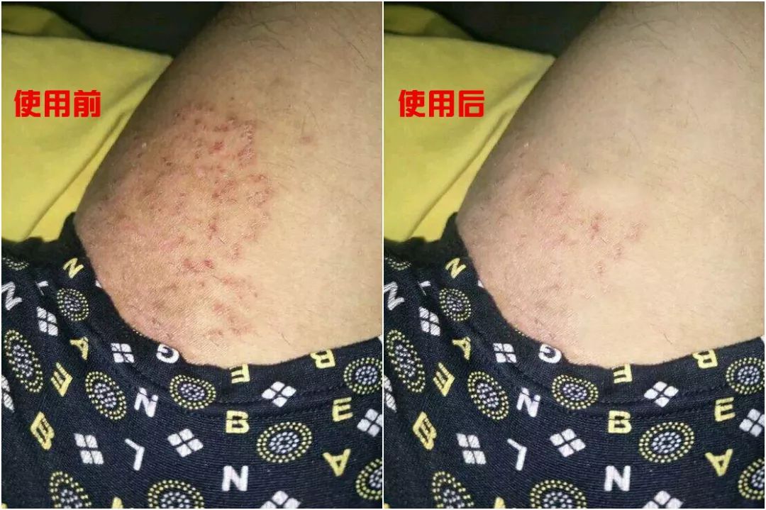 坐立不安,心力交瘁红斑脱屑丘疱疹不断反复蔓延夏季闷热潮湿容易出汗