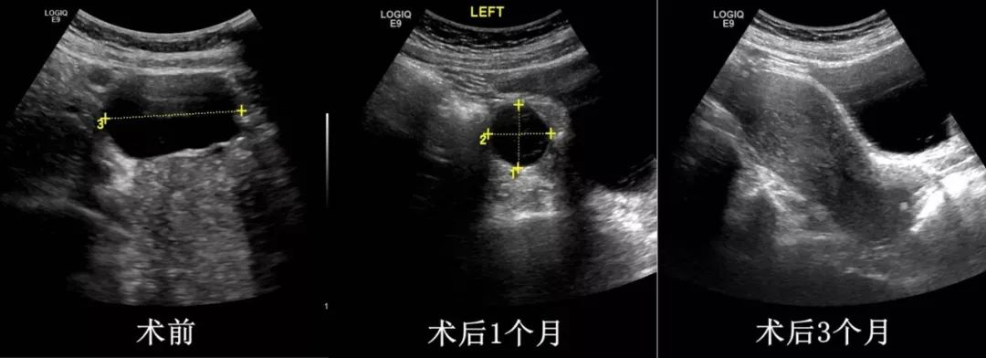 肠系膜囊肿超声图片图片