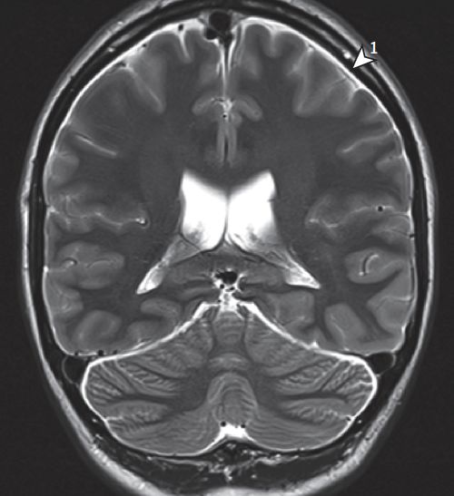 jaman容易忽视的低颅压mri征象