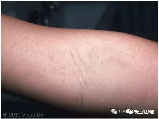 帕氏线:猩红热的患儿,在皮肤皱褶处,比如腋窝,肘窝等处,皮疹比较密集