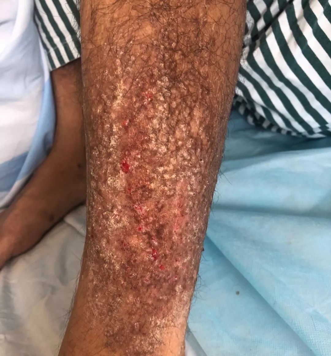 确诊患有皮肤淀粉样变张先生到我院皮肤科就诊后痛痒得他恨不得用刀割