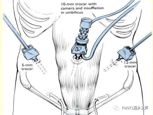 在腹部打三个小洞解决这个能曲能伸的小东西
