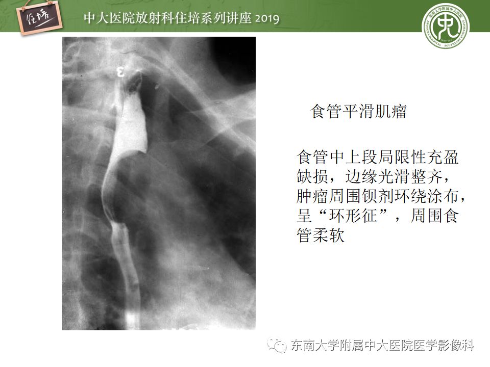 食管平滑肌瘤x线图片