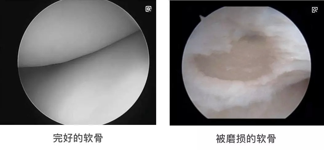 关节腰背肩颈一吹空调就酸疼为什么骨科医生提醒你保护软骨