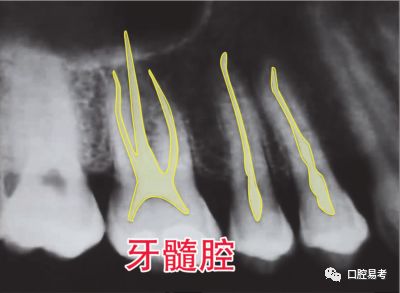 上頜可見解剖結構:下頜可見解剖結構:全口牙為曲面體層片:根尖周膿腫