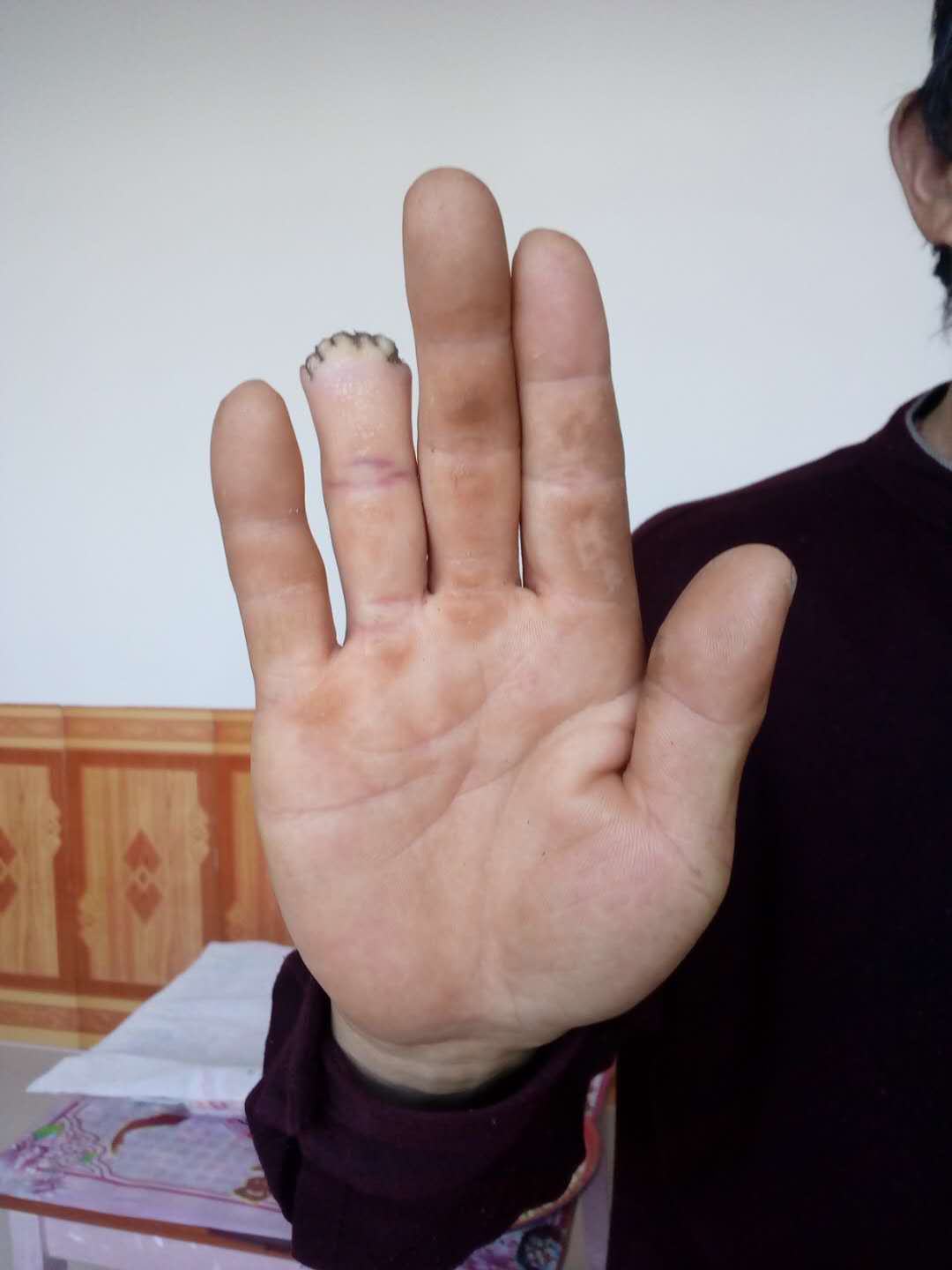 黑心包工头——李万江,砍掉农民工手指,该怎么办?求关注,维权!