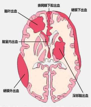 蛛网膜下腔出血ct解读图片