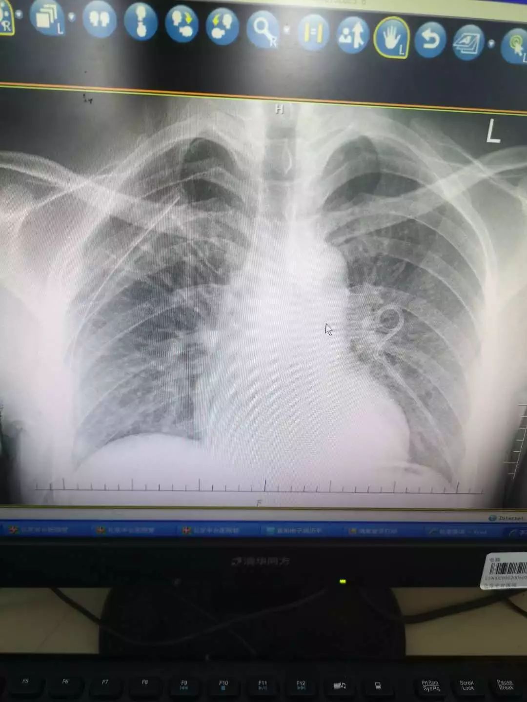 研究,与麻醉科密切配合,亲自主刀,为患者行肺大泡切除术及胸膜固定术