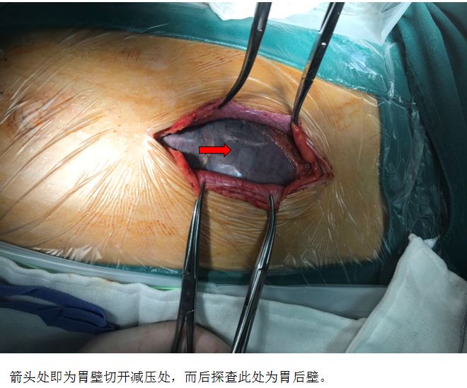 从膈下到盆腔你见过这么严重的胃扩张吗