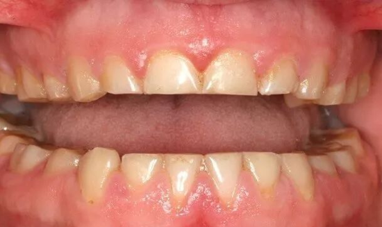 夜磨牙是怎么回事这锅肚子里的虫子不背