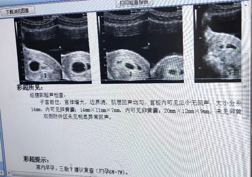 百日助孕高龄产妇多年未孕3个月后竟喜获三胞胎70万分之一的概率都被